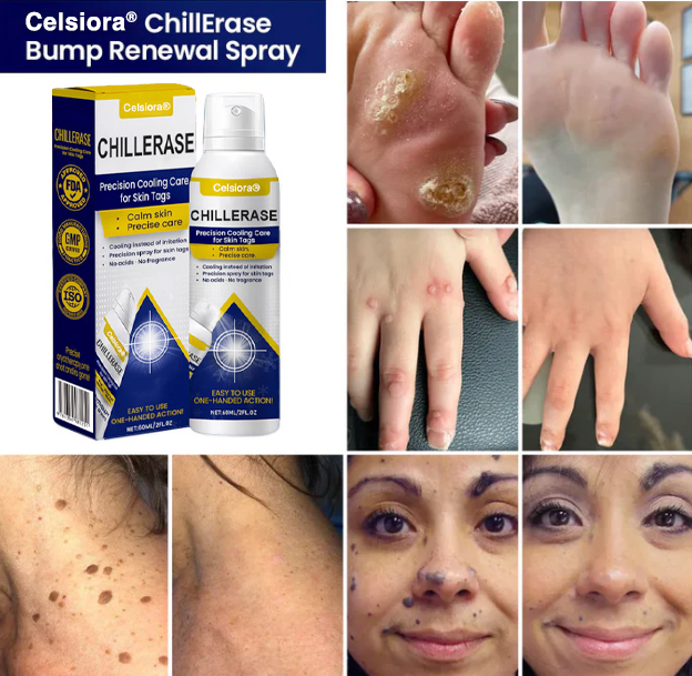⭐️Jhati® ChillErase Cooling Spray for Skin Tags
