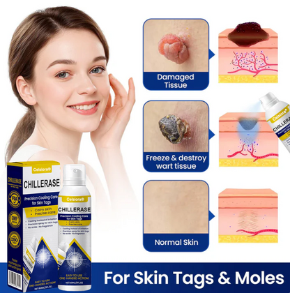 ⭐️Jhati® ChillErase Cooling Spray for Skin Tags