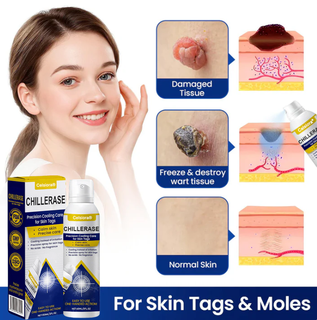 Jhati® ChillErase Cooling Spray for Skin Tags