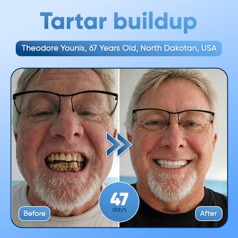 Your Smile~🦷Tideglusib Fast‑Dissolving Tooth & Gum Repair Oral Strips✨ (𝟓-𝐢𝐧-𝟏 💎 𝐑𝐞𝐛𝐮𝐢𝐥𝐝 𝐄𝐧𝐚𝐦𝐞𝐥 & 𝐃𝐞𝐧𝐭𝐢𝐧 • 𝐒𝐭𝐫𝐞𝐧𝐠𝐭𝐡𝐞𝐧 𝐆𝐮𝐦𝐬 • 𝐄𝐫𝐚𝐝𝐢𝐜𝐚𝐭𝐞 𝐓𝐚𝐫𝐭𝐚𝐫 & 𝐎𝐝𝐨𝐫 • 𝐖𝐡𝐢𝐭𝐞𝐧𝐢𝐧𝐠 • 𝐒𝐭𝐨𝐩 𝐓𝐨𝐨𝐭𝐡 𝐒𝐞𝐧𝐬𝐢𝐭𝐢𝐯𝐢𝐭𝐲)