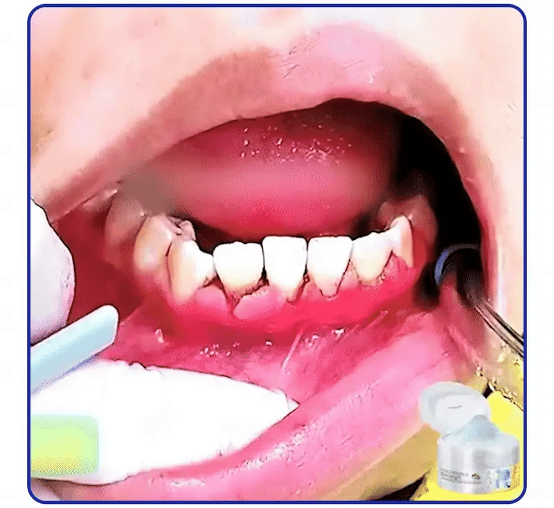 ⭐️Furzero® Focussmile bee venom treatment powder for oral use🦷