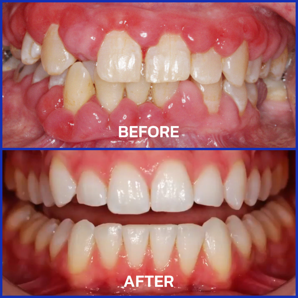 🏆Furzero® Focussmile bee venom treatment powder for oral use🦷